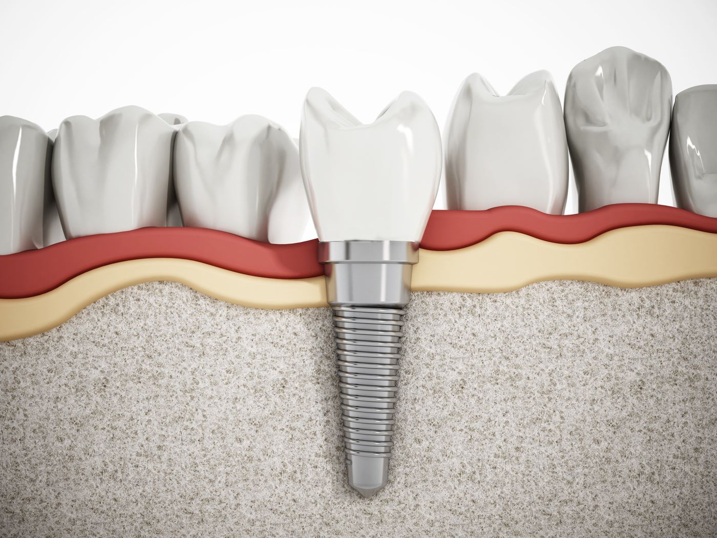 Cross-section showing a dental implant in the jawbone with an abutment and crown between natural teeth