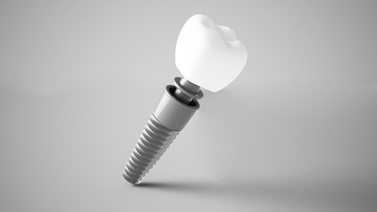 Model of a dental implant with abutment and crown